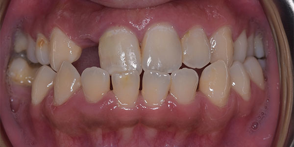 Before treatment the patient had worn teeth with some gapping